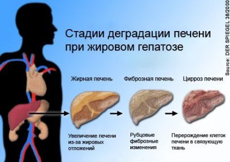 жировой гепатоз стадии