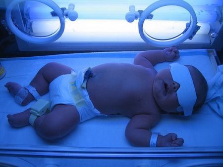 фототерапия новорожденному