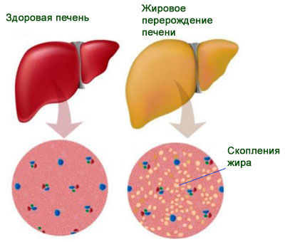 жировой гепатоз